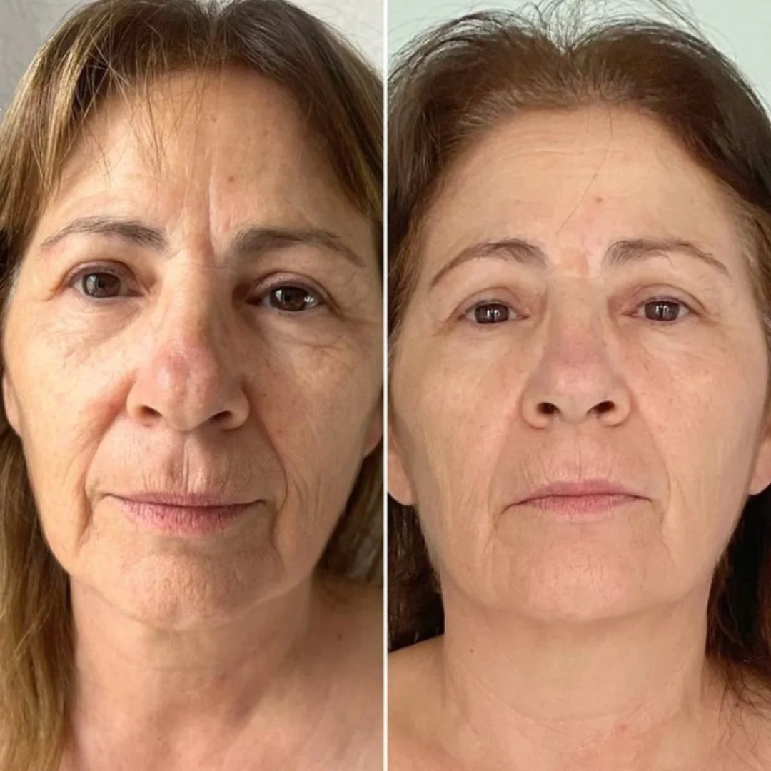 SkinPro - Reafirma la piel flácida del rostro en solo 5 minutos al día