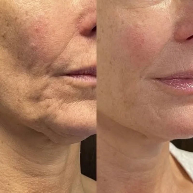 SkinPro™ – Reduce la Flacidez y las Arrugas en Solo 14 Días