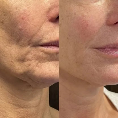 SkinPro™ – Reduce la Flacidez y las Arrugas en Solo 14 Días